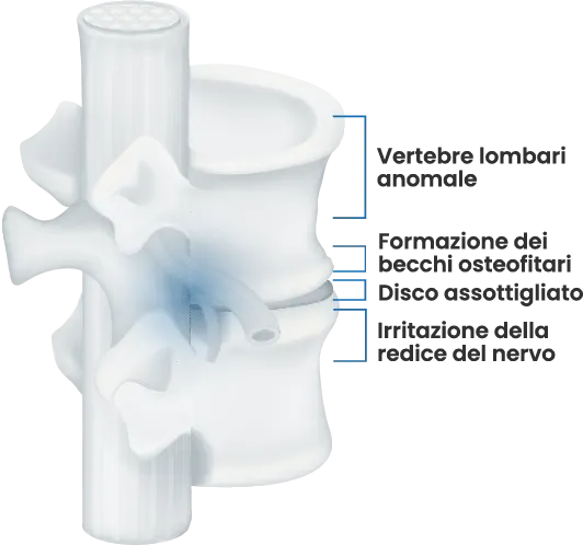 Raffigurazione di una anomalia nelle vertebre lombari